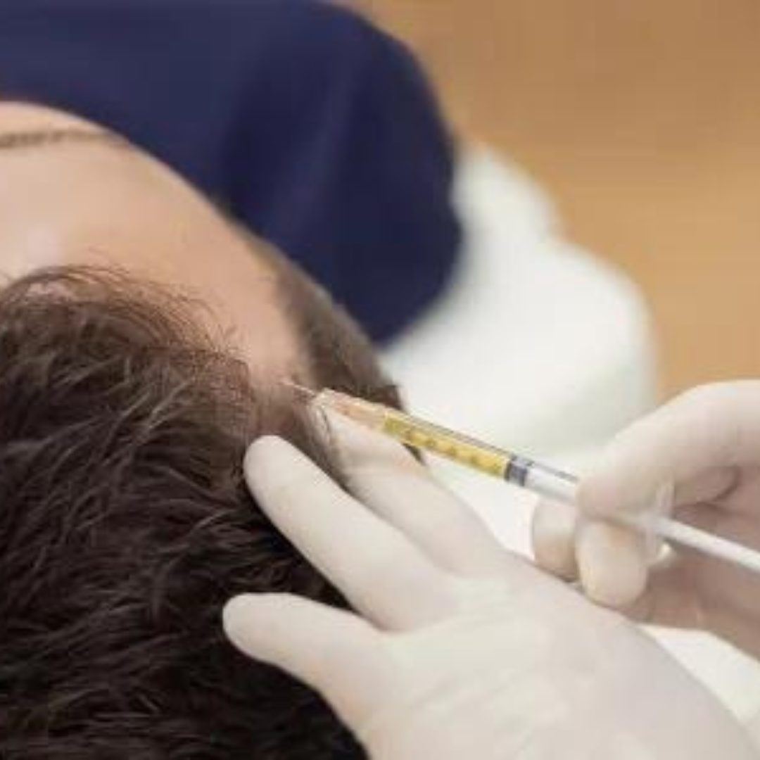 PRF Hair Loss Therapy